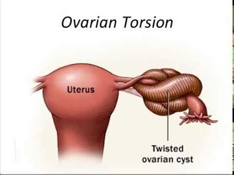 test for ovarian torsion|ovarian torsion recovery time.